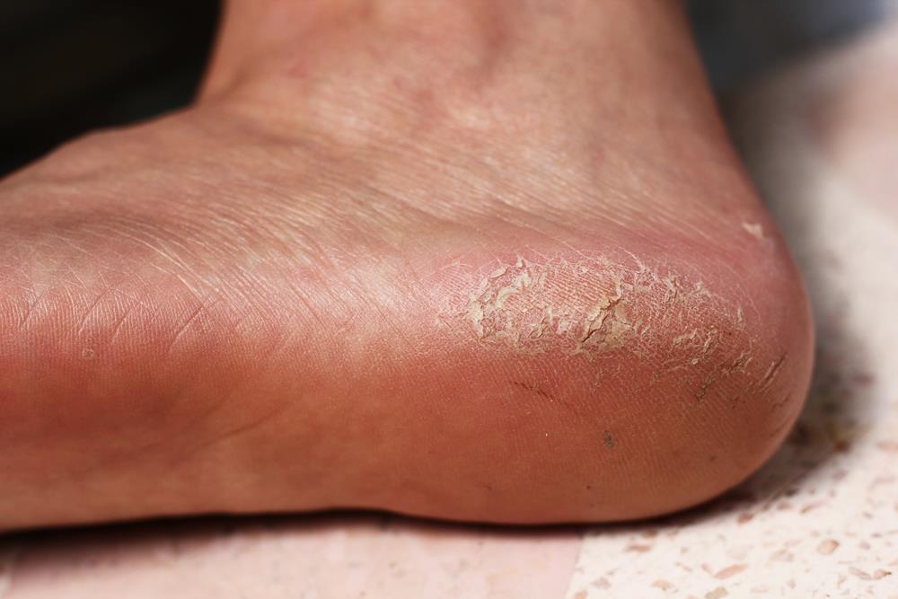 Calluses  Thousand Oaks, CA 